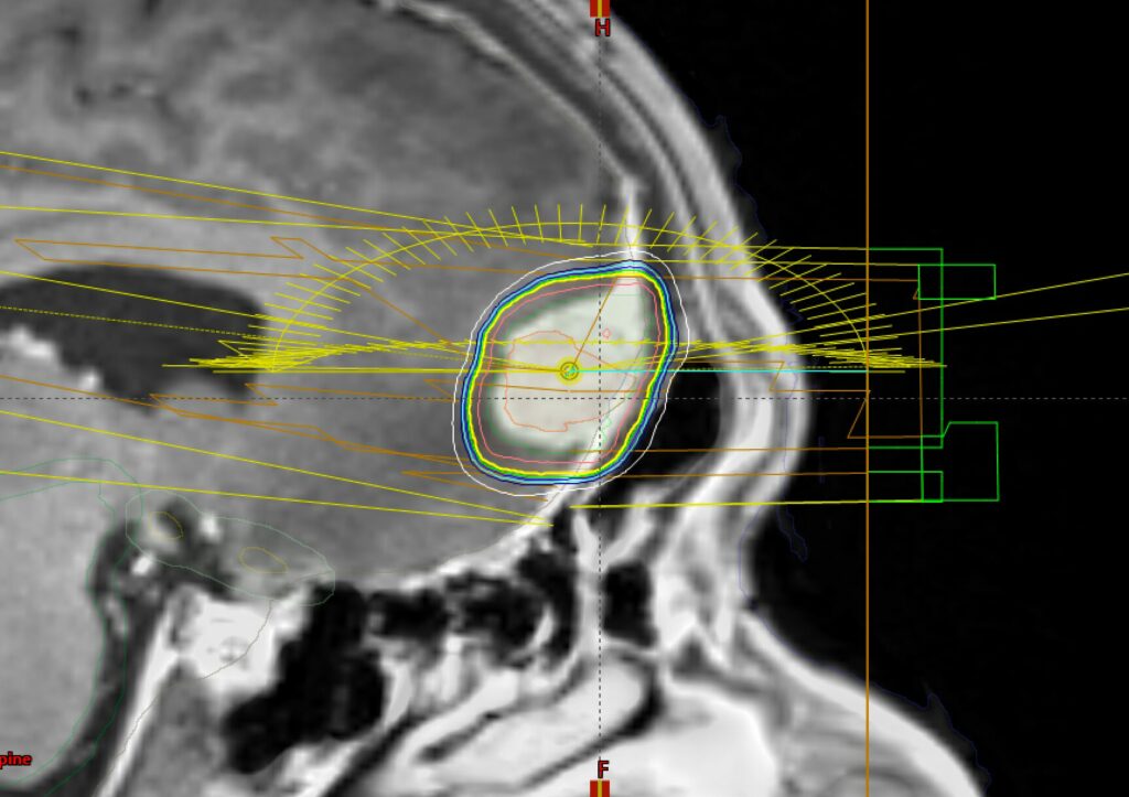 meningioma
